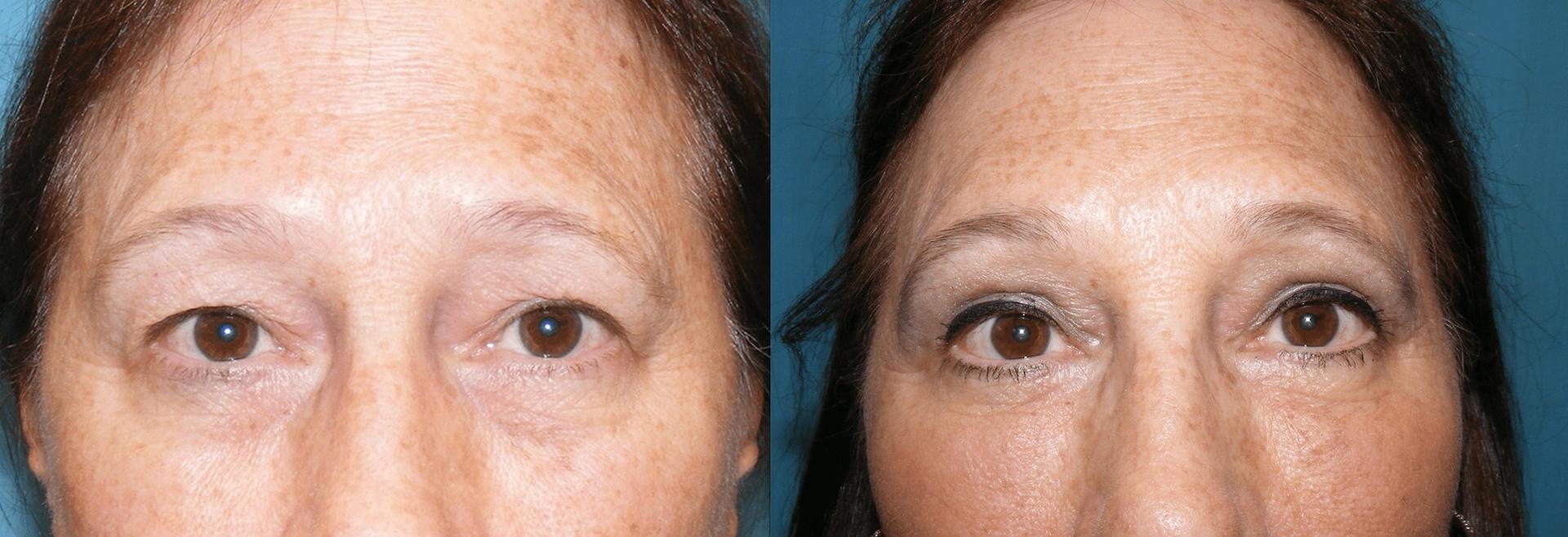 San Diego Surgical Arts eyelid lift result — San Diego, CA