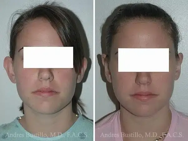 Dr. Andres Bustillo - Facial Plastic Surgery otoplasty result — Miami, FL