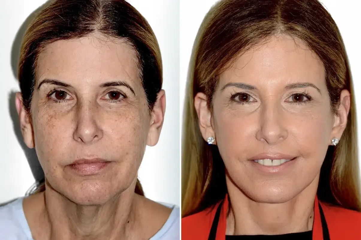 Dr. Andres Bustillo - Facial Plastic Surgery facelift result — Miami, FL