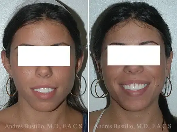 Dr. Andres Bustillo - Facial Plastic Surgery otoplasty result — Miami, FL