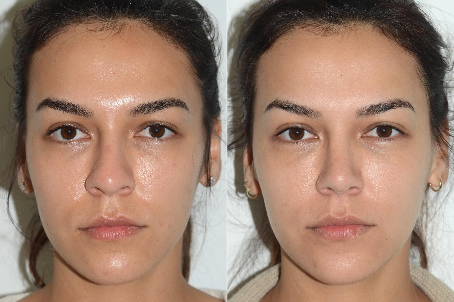 Dr. Andres Bustillo - Facial Plastic Surgery rhinoplasty result — Miami, FL