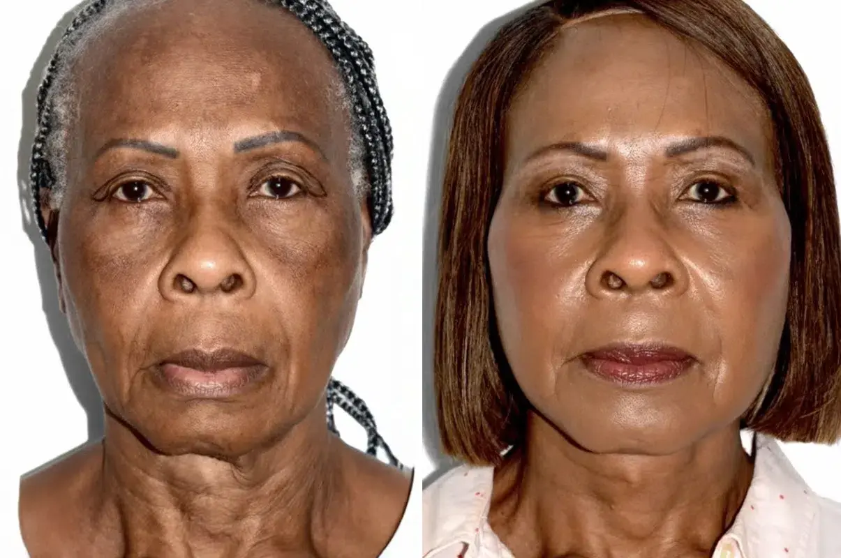 Dr. Andres Bustillo - Facial Plastic Surgery facelift result — Miami, FL