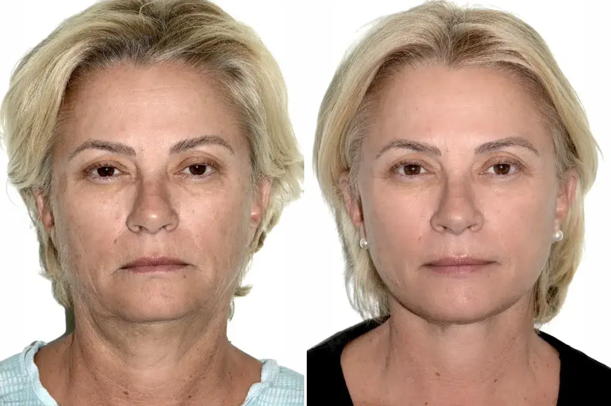 Dr. Andres Bustillo - Facial Plastic Surgery facelift result — Miami, FL