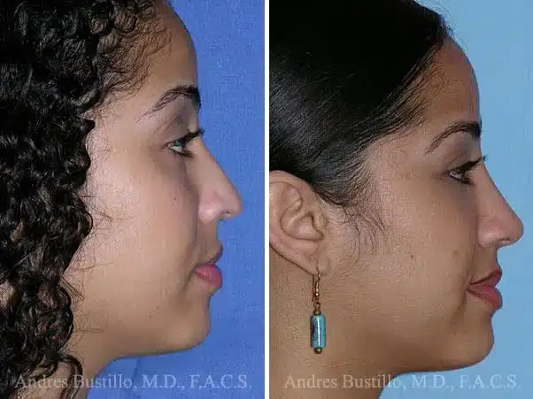 Dr. Andres Bustillo - Facial Plastic Surgery rhinoplasty result — Miami, FL