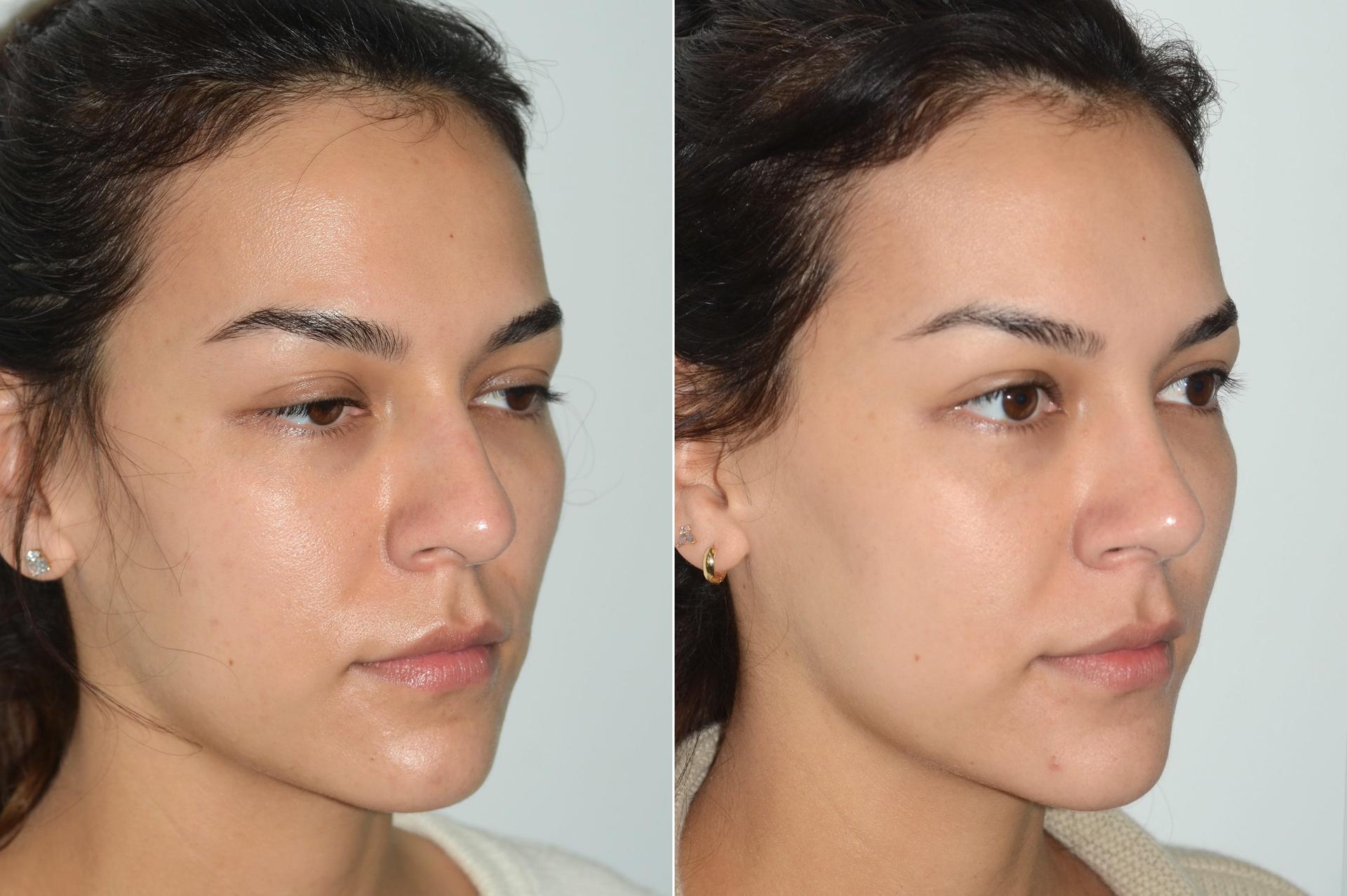 Dr. Andres Bustillo - Facial Plastic Surgery rhinoplasty result — Miami, FL