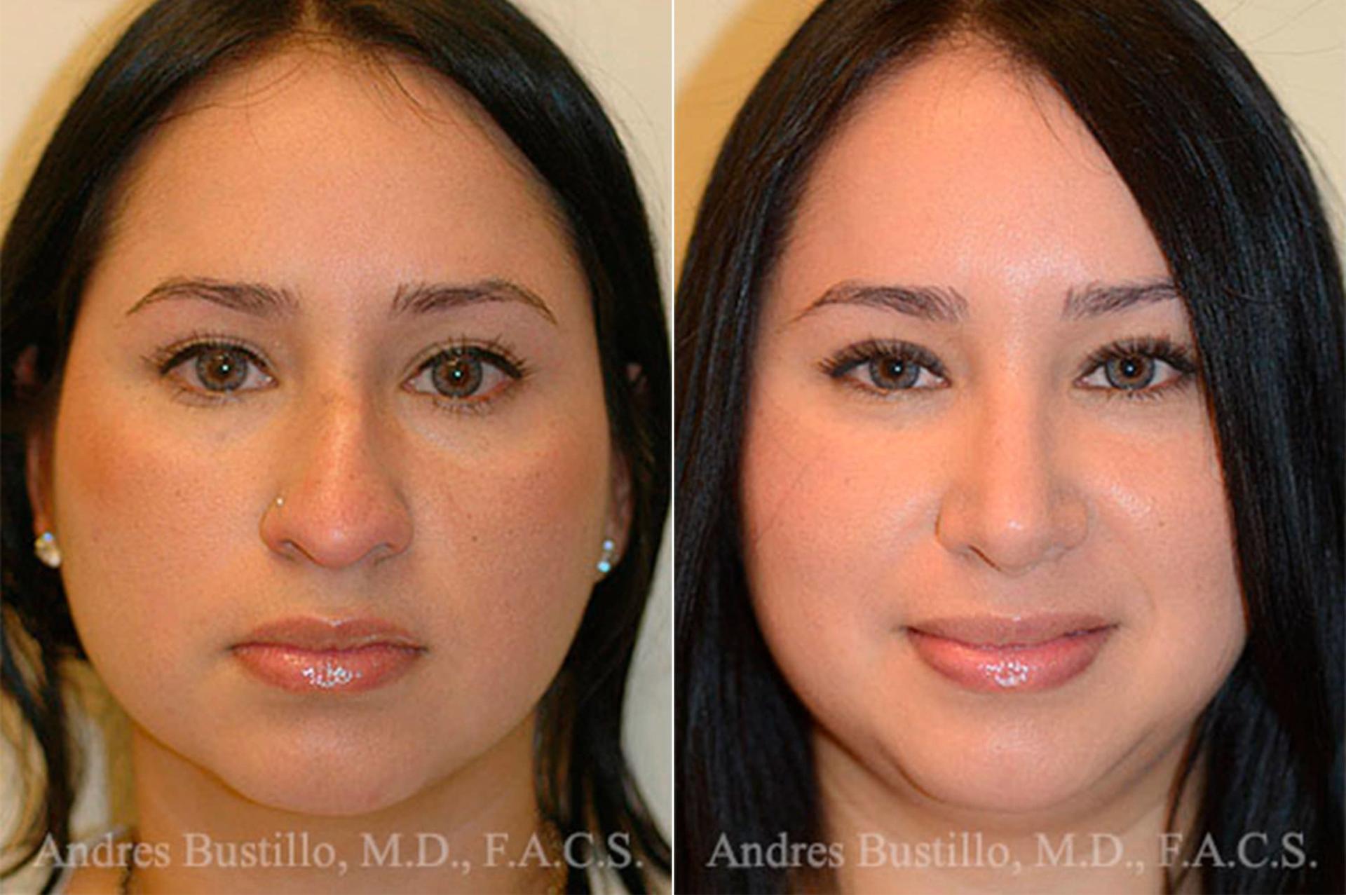 Dr. Andres Bustillo - Facial Plastic Surgery rhinoplasty result — Miami, FL