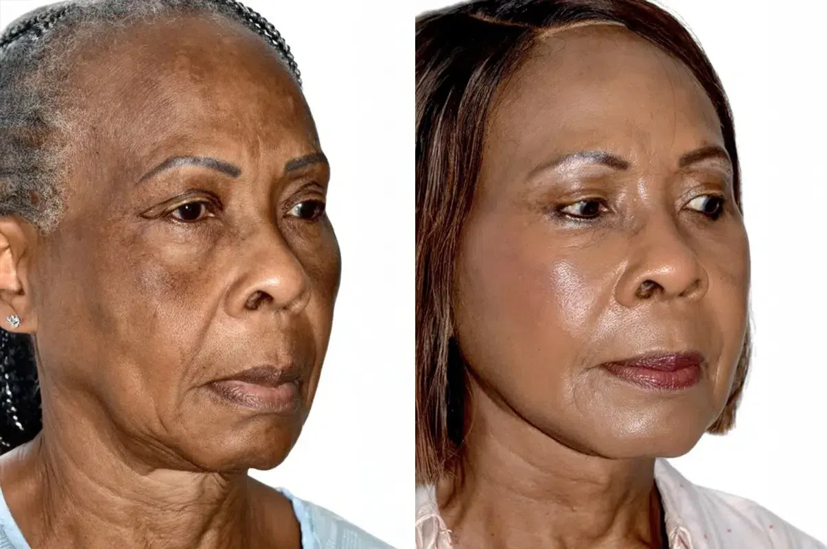 Dr. Andres Bustillo - Facial Plastic Surgery facelift result — Miami, FL