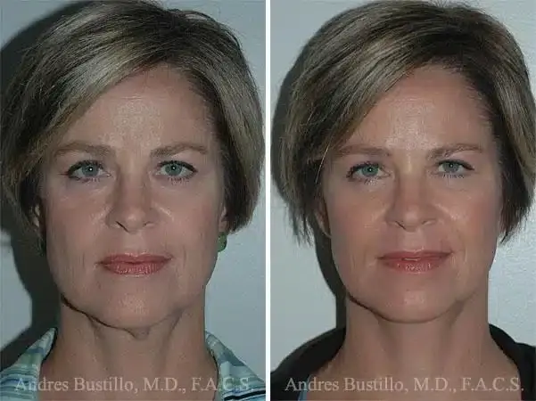 Dr. Andres Bustillo - Facial Plastic Surgery neck lift result — Miami, FL