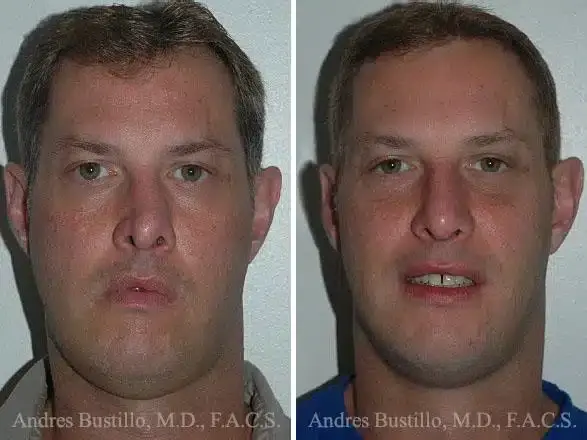 Dr. Andres Bustillo - Facial Plastic Surgery rhinoplasty result — Miami, FL