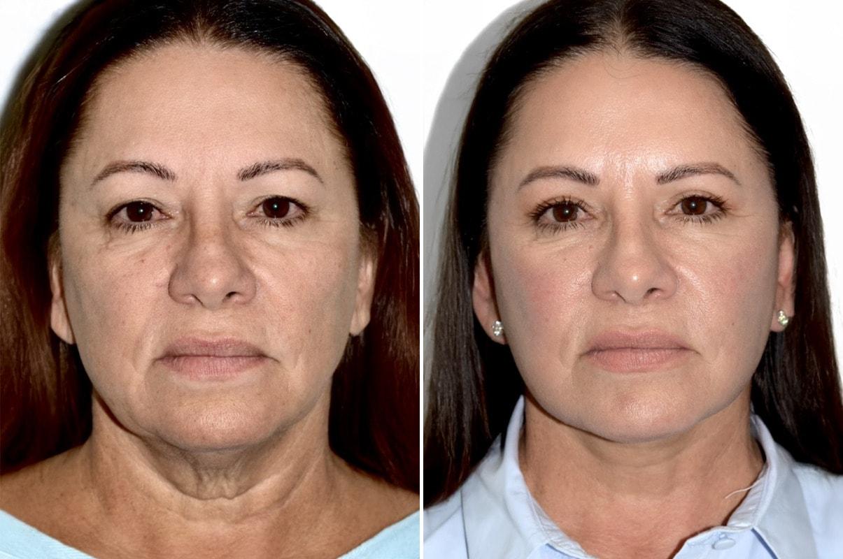 Dr. Andres Bustillo - Facial Plastic Surgery facelift result — Miami, FL