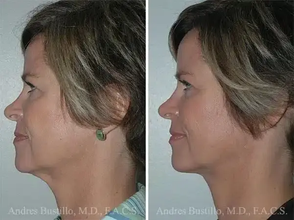 Dr. Andres Bustillo - Facial Plastic Surgery neck lift result — Miami, FL