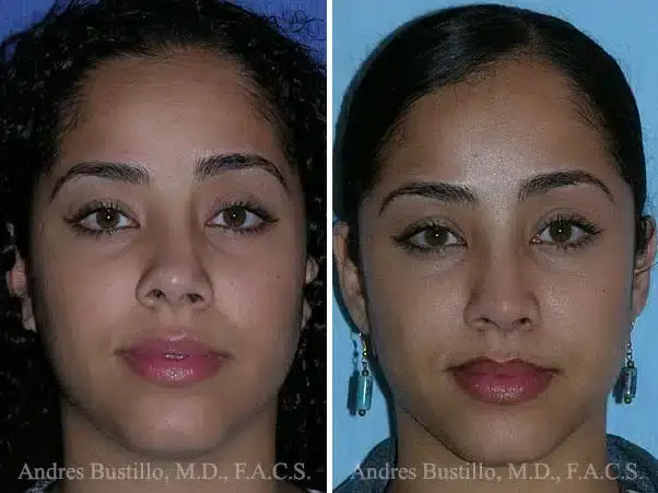 Dr. Andres Bustillo - Facial Plastic Surgery rhinoplasty result — Miami, FL