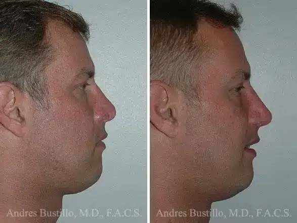 Dr. Andres Bustillo - Facial Plastic Surgery rhinoplasty result — Miami, FL