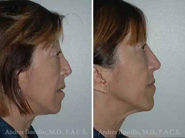Dr. Andres Bustillo - Facial Plastic Surgery rhinoplasty result — Miami, FL