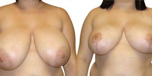 Azouz Plastic & Cosmetic Surgery result — Dallas, TX