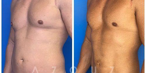 Gynecomastia Surgery result at Azouz Plastic & Cosmetic Surgery in Dallas, TX
