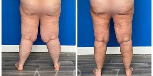 Azouz Plastic & Cosmetic Surgery result — Dallas, TX