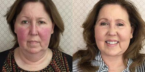 Facelift result at Azouz Plastic & Cosmetic Surgery in Dallas, TX