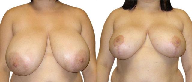 Breast Reduction result at Azouz Plastic & Cosmetic Surgery in Dallas, TX