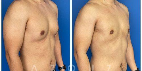 Gynecomastia Surgery result at Azouz Plastic & Cosmetic Surgery in Dallas, TX