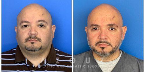 Azouz Plastic & Cosmetic Surgery result — Dallas, TX