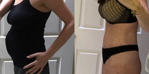 Azouz Plastic & Cosmetic Surgery result — Dallas, TX