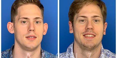 Azouz Plastic & Cosmetic Surgery result — Dallas, TX