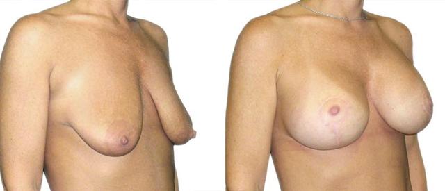 Breast Lift result at Azouz Plastic & Cosmetic Surgery in Dallas, TX