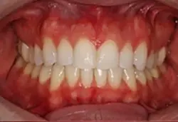 Coastal Dental Arts smile makeover after — San Diego, CA
