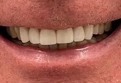 Coastal Dental Arts smile makeover after — San Diego, CA
