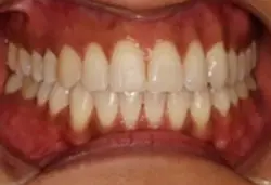 Coastal Dental Arts smile makeover after — San Diego, CA
