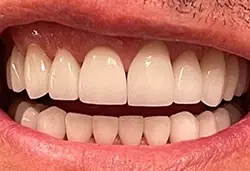 Smile Makeover after at Coastal Dental Arts in San Diego, CA