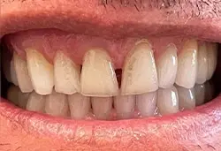 Smile Makeover before at Coastal Dental Arts in San Diego, CA
