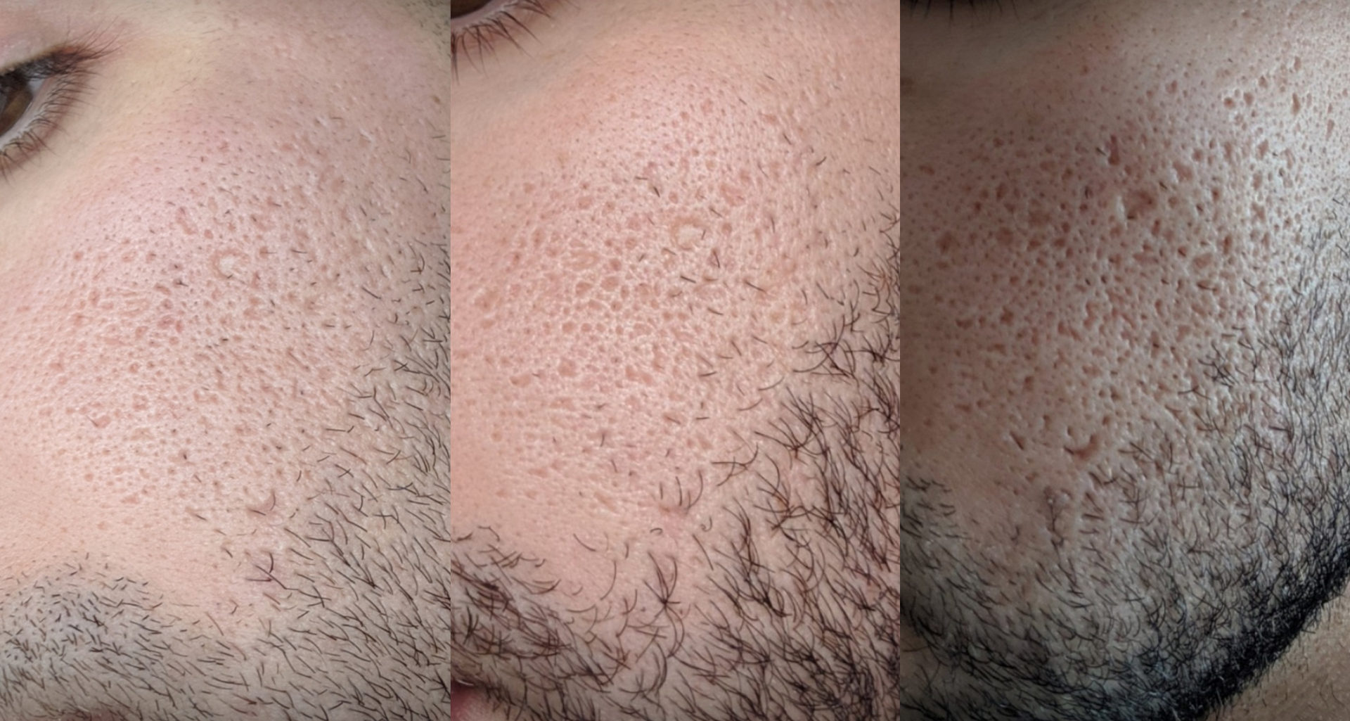 Aesthetic Center of Columbia microneedling result — Columbia, MD