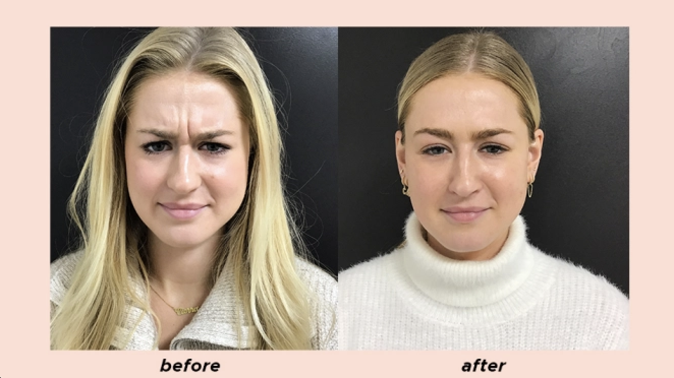 Aesthetic Center of Columbia result — Columbia, MD