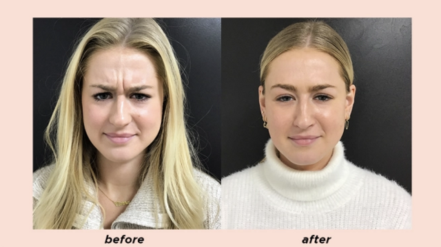 Botox result at Aesthetic Center of Columbia in Columbia, MD