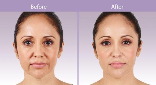 Aesthetic Center of Columbia result — Columbia, MD