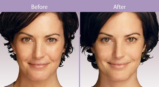 Aesthetic Center of Columbia result — Columbia, MD