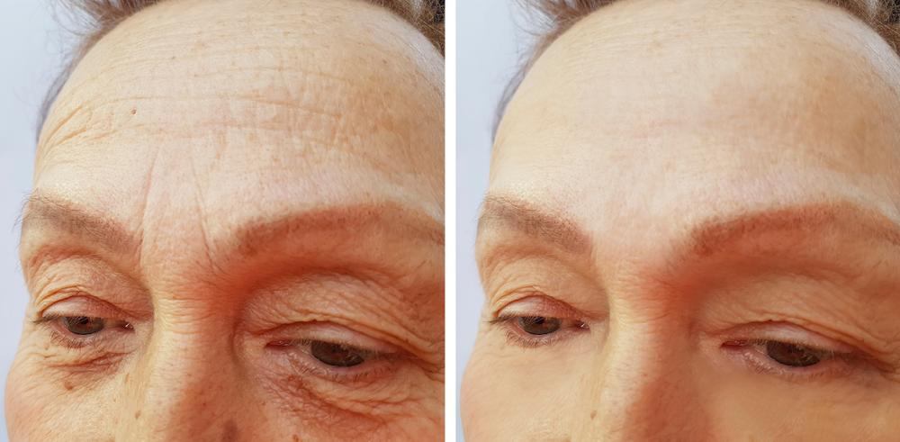 Aesthetic Center of Columbia result — Columbia, MD