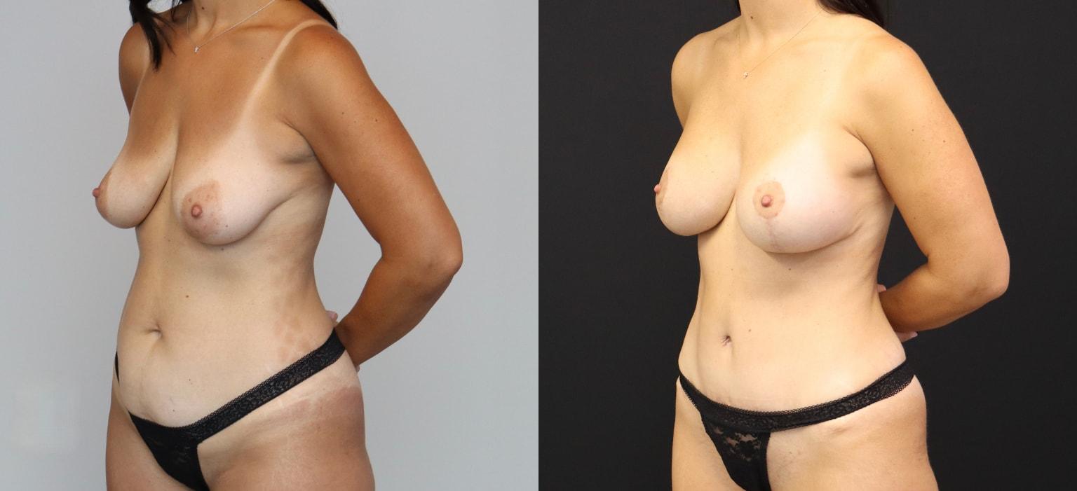 U Plastic Surgery + Aesthetics mommy makeover after — Owings Mills, MD