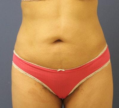 U Plastic Surgery + Aesthetics liposuction after — Owings Mills, MD
