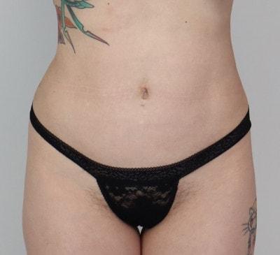 U Plastic Surgery + Aesthetics liposuction after — Owings Mills, MD