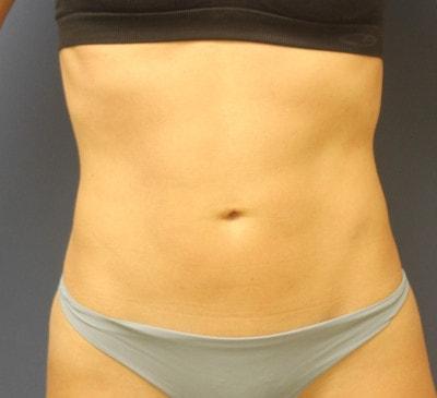 U Plastic Surgery + Aesthetics liposuction after — Owings Mills, MD