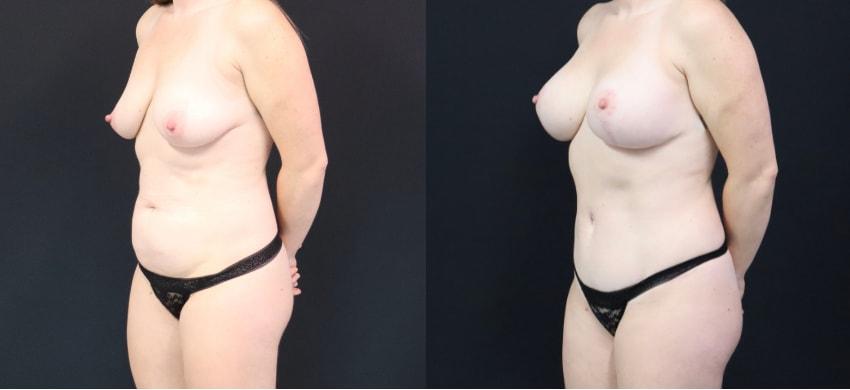 U Plastic Surgery + Aesthetics mommy makeover after — Owings Mills, MD