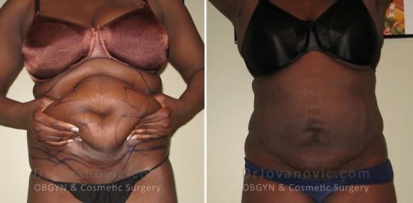 Liposuction result at Dr. Jovanovic, OBGYN & Cosmetic Surgery in New York, NY