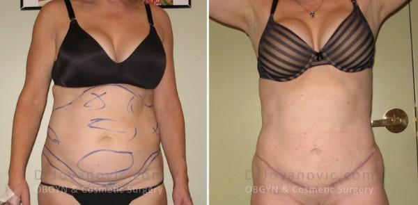 Tummy Tuck result at Dr. Jovanovic, OBGYN & Cosmetic Surgery in New York, NY