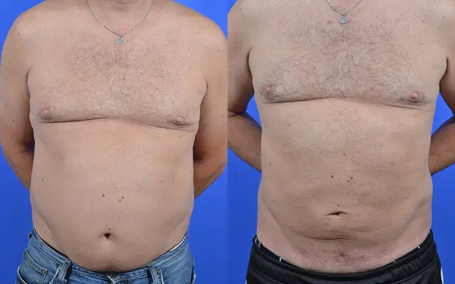 Liposuction result at Samer W. Cabbabe, MD | Board - Certified Plastic Surgeon in St. Louis, MO