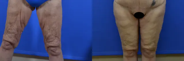 Arm Lift result at Samer W. Cabbabe, MD | Board - Certified Plastic Surgeon in St. Louis, MO