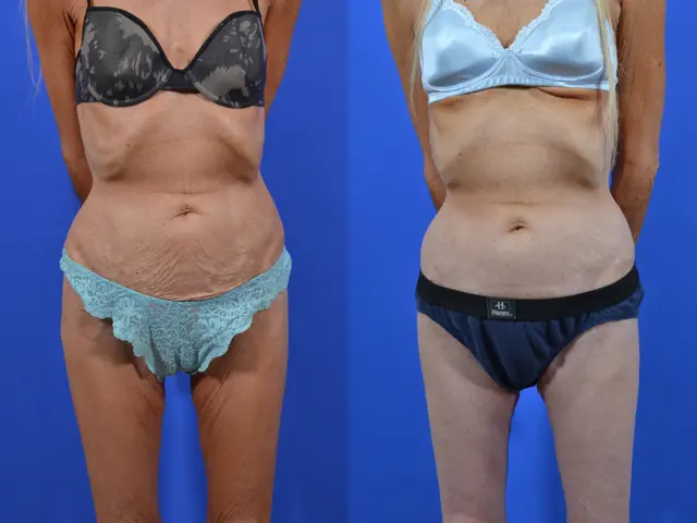 Thigh Lift result at Samer W. Cabbabe, MD | Board - Certified Plastic Surgeon in St. Louis, MO