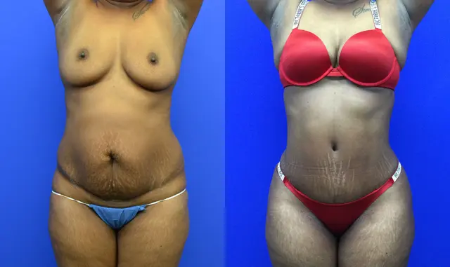 Tummy Tuck result at Samer W. Cabbabe, MD | Board - Certified Plastic Surgeon in St. Louis, MO